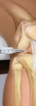 تزریق در مفصل زانو-ارتوپد